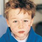 Molluscum contagiosum gyermekeknél Molluscum contagiosum gyermekeknél