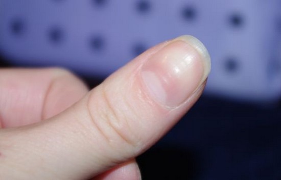 Cuticle eltávolítás