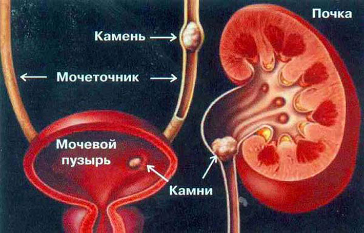Vese kövek: népi gyógymódok