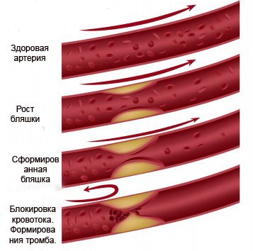 Atherosclerosis kezelése népi gyógymódokkal