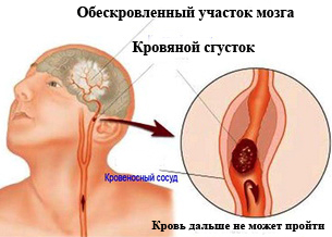 Atherosclerosis kezelése népi gyógymódokkal