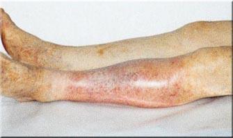 Atherosclerosis kezelése népi gyógymódokkal