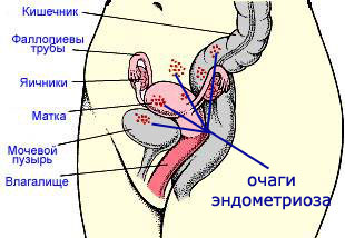 Endometriosis: népi gyógymódok