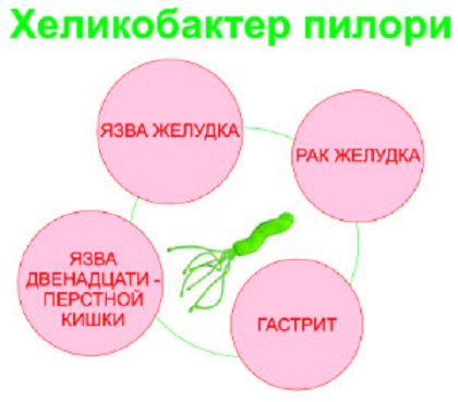 Gyomorfekély kezelése népi gyógymódokkal