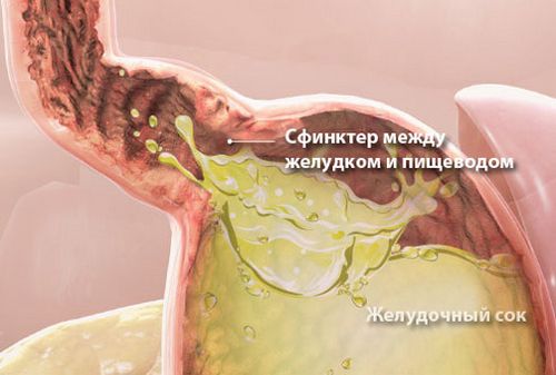 Mi a teendő, ha gyomorégést okoz