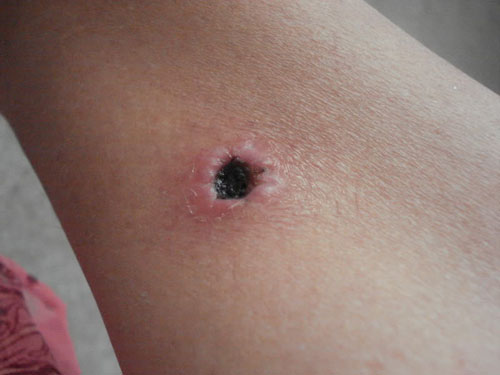 Mi a fistula? Tünetek, fotók, fistula kezelés