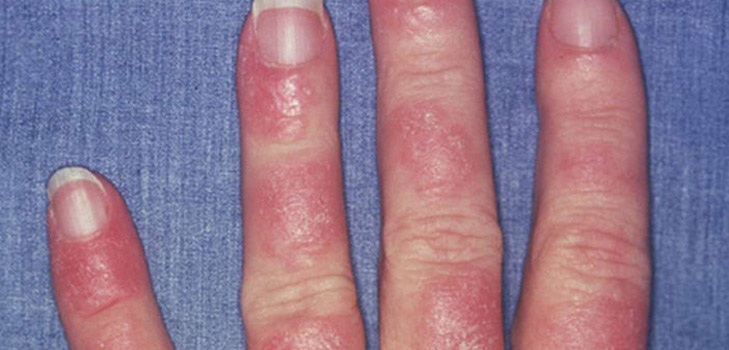 Mi a lupus? A betegség tünetei és okai