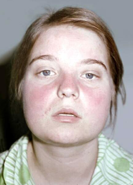 Mi a lupus? A betegség tünetei és okai