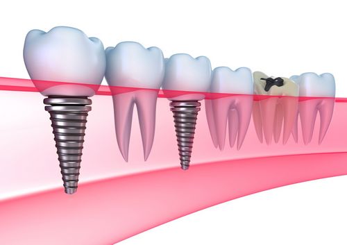 A fogászati ​​implantáció luxus vagy szükségszerűség? 