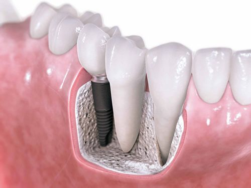 A fogászati ​​implantáció luxus vagy szükségszerűség? 