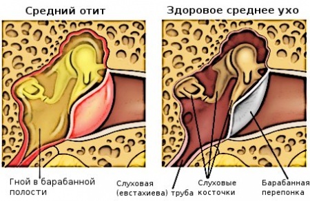 Hogyan kezeljük az otitis-ot az otthonban?