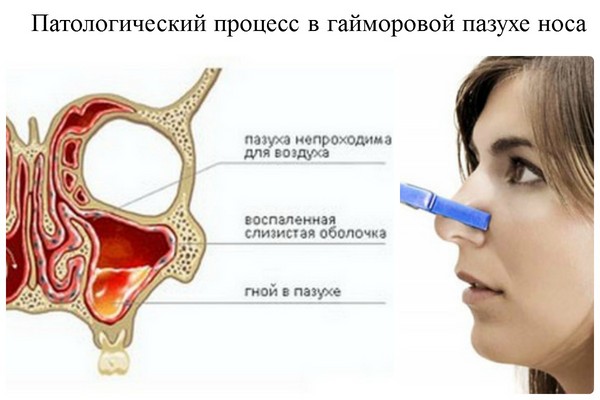 Barna roncs: miért fontos időben kezelni a kezelést?