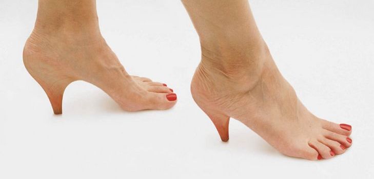 Heel spurs: népi gyógymódokkal végzett kezelés
