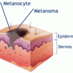A bőr melanoma
