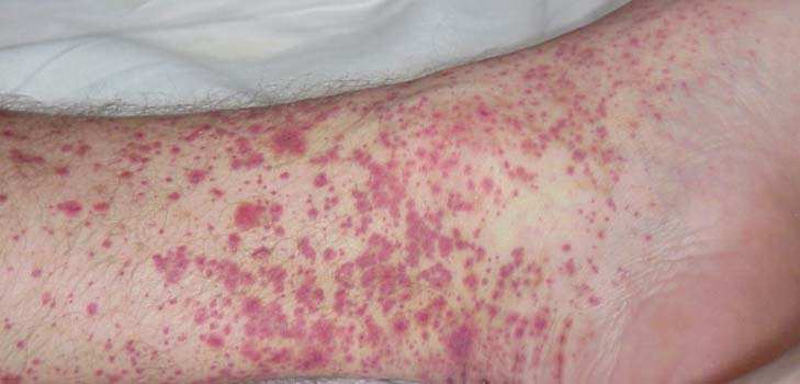 Vasculitis - mi ez? Tünetek, fotók, kezelés